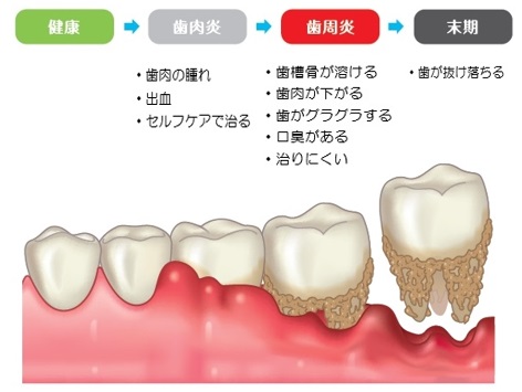 歯周病は人類最大の感染病 おかだ歯科クリニック